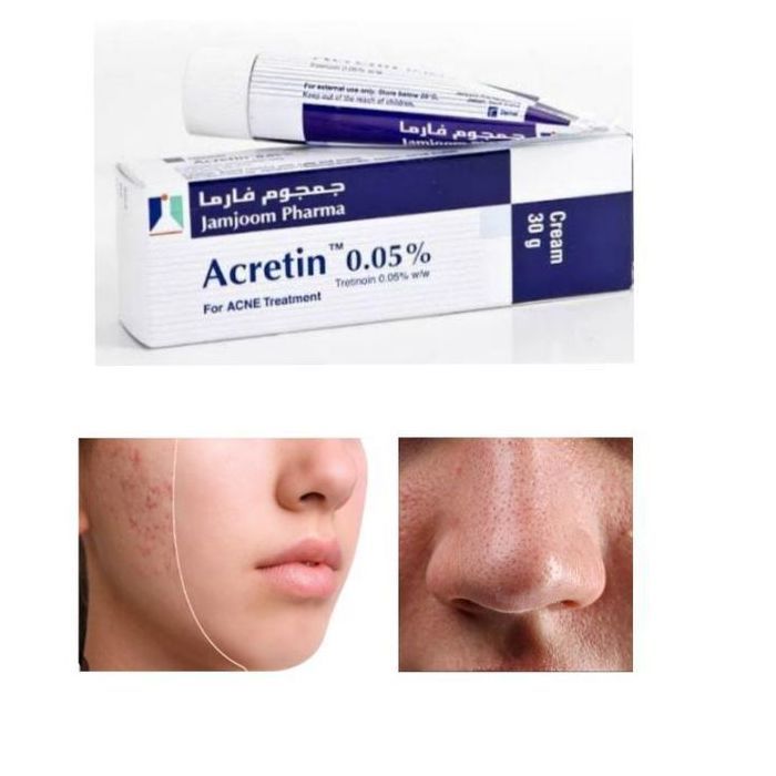 Acretin Crème 0,05 % contre l'acné (trétinoïne) et pores dilatés 30 g- made KSA