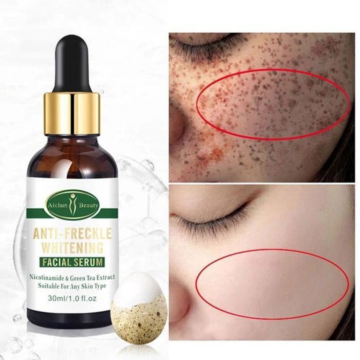 Aichun beauty sérum pour le visage anti-taches de rousseur, blanchissant, élimine les pigments de mélanine, les taches foncées